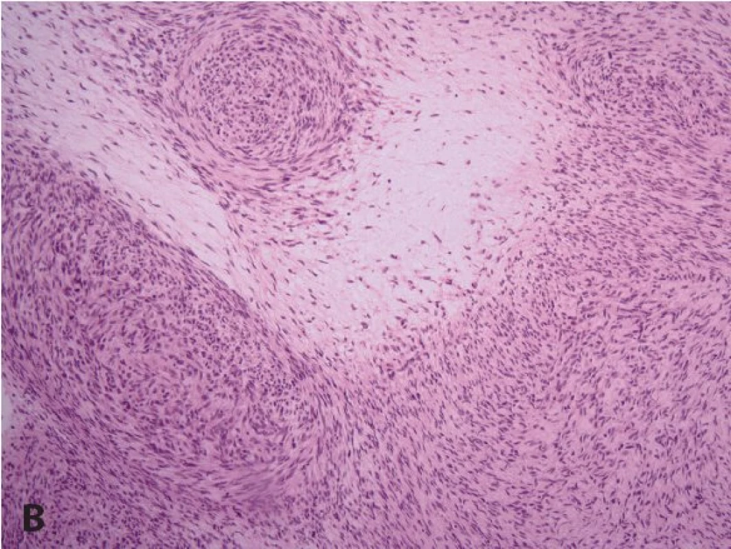A: U plexiformního neurofibromu jsou původní nervová vlákna už makroskopicky expandována. V porovnání s difúzním neurofibromem bývá často plexiformní neurofibrom myxoidně změněný (HE, 200x). B: Transformace plexiformního neurofibromu do maligního nádoru pochvy periferního nervu (MPNST) u pacienta s neurofibromatózou (HE, 200x).