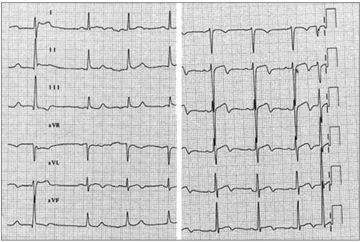 EKG po přijetí do nemocnice.