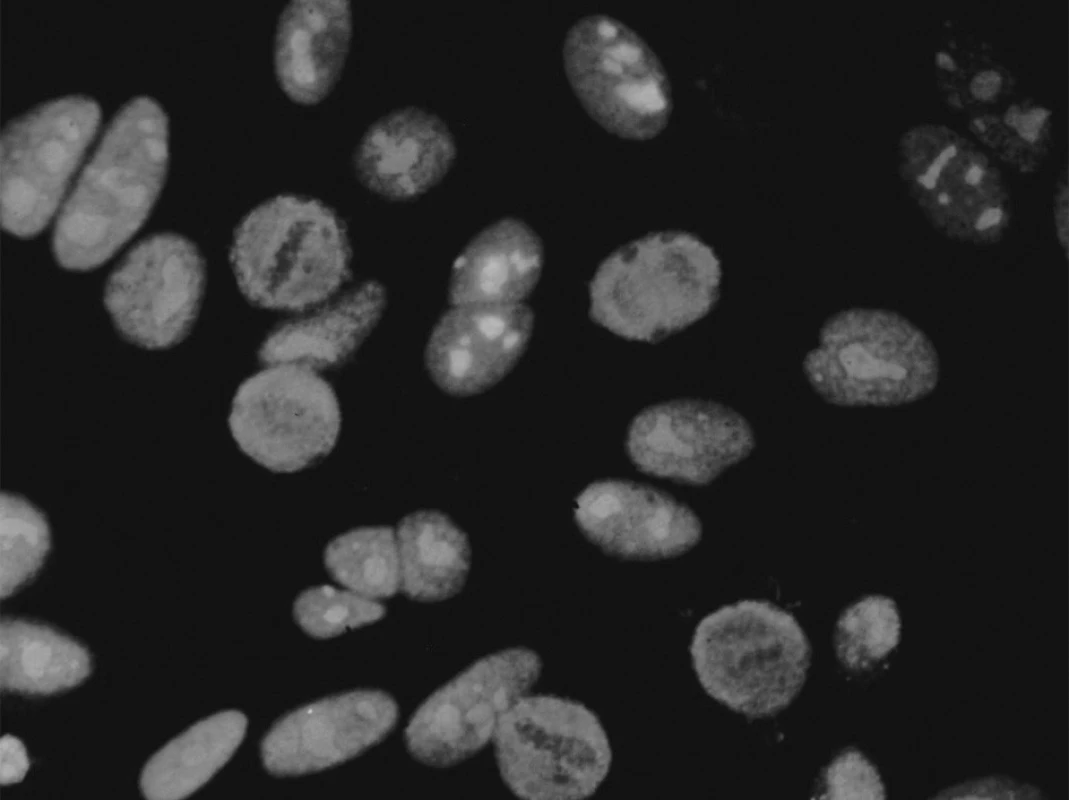 Anti-Pm-Scl produkují homogenní jadérkovou fluorescenci
na Hep-2 buňkách při nepřímé imunofluorescenci.
Mírnou jemně granulární fluorescenci vykazuje také jádro.
V dělících se buňkách jsou v metafázi chromozomy negativní
a nebarví se ani NOR (nucleolar organising region), na rozdíl
chomáčkovité nebo skvrnité nukleolární fluorescence způsobené
protilátkami proti fibrilarinu či RNA polymeráze, kde bývají
další doprovodné změny v dělících se buňkách.
Obr. 3. Reaktivita na PM1-α (a) a na PM-Scl-100 (b) u pacientů
s polymyositidou (PM), systémovou sklerózou (Scl)
a s překryvným syndromem PM/Scl (data převzata z (6, 17)).
revma 4 zlom 14.1.2010 9:25 Str. 202
