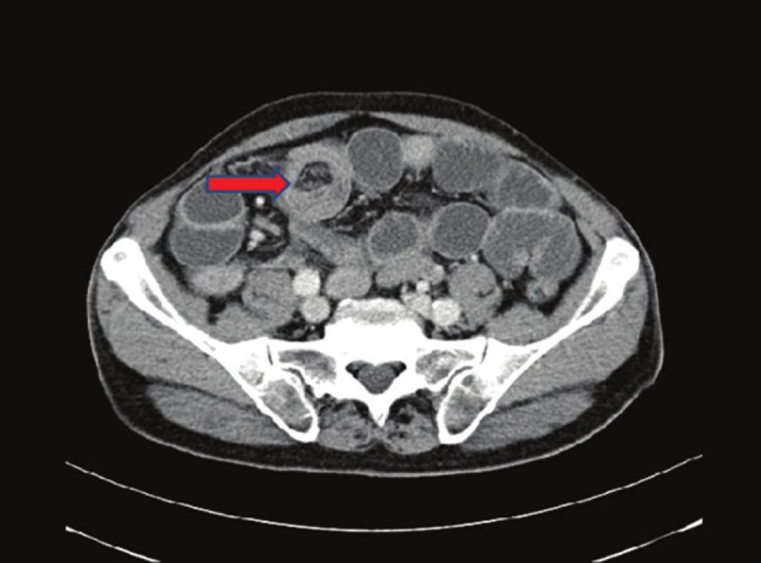 CT břicha − nativně a postkontrastně: v oblasti malé pánve patrné solidní ložisko velikosti 67x63x58mm− jde s velkou pravděpodobností o TU colon sigmoideum. Divertikulosa orálního sigmoidea.
Fig. 2: Nonenhanced and contrast-enhanced abdominal CT scan: a solid mass measuring 67x63x58 mm located in the lesser pelvis – very probably an image of a sigmoid colon tumor. Diverticulosis of the proximal sigmoid colon.