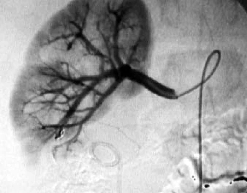 Kontrolní angiografie pravé renální tepny po embolizaci, bez známek plnění AV-zkratu.