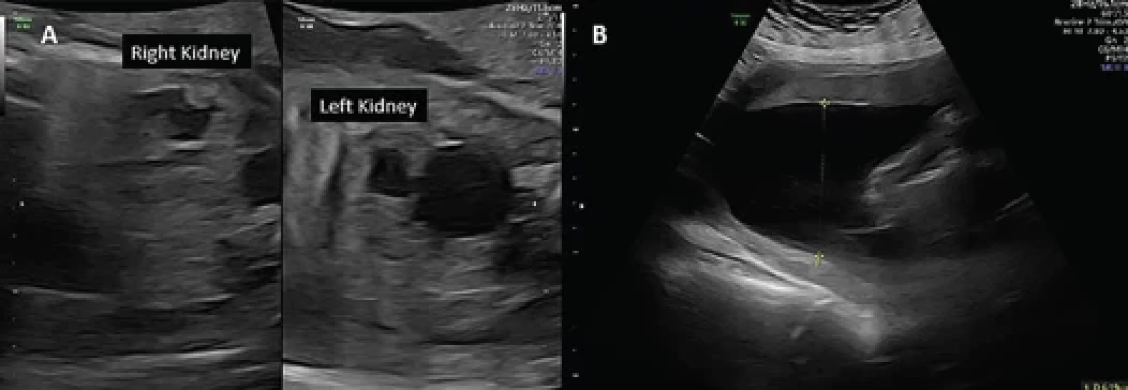 Ultrasound at 15 days after laser fulguration of the posterior urethral valves.