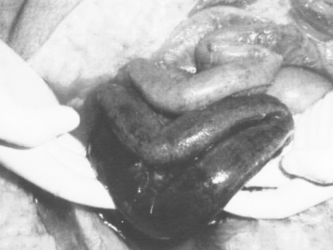 Gangréna tenkého čreva – venózny uzáver
Pic. 2. Gangrene of the small intestine – venous closure