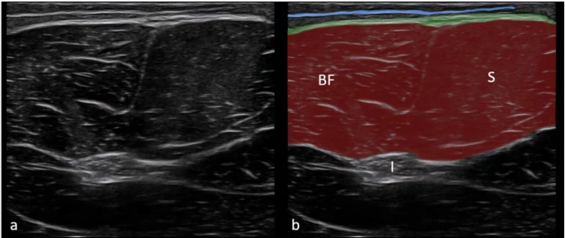 Zobrazení fascia lata v lokalizaci posterior na nativním sonografickém snímku (a) a na barevně zvýrazněném sonografickém snímku (b). Superficiální fascie je znázorněna modrou linií. Hluboká fascie (zelená linie) přechází přes m. biceps femoris a m. semitendinosus, mezi nimiž se nachází intermuskulární septum.  Fig. 6. Imaging of the fascia lata in the posterior location in the original ultrasound image (a) and in a color-enhanced ultrasound image (b). The superficial fascia is represented by a blue line. The deep fascia is represented by a green line over the biceps femoris and semitendinosus muscles with intermuscular septa located between them. 