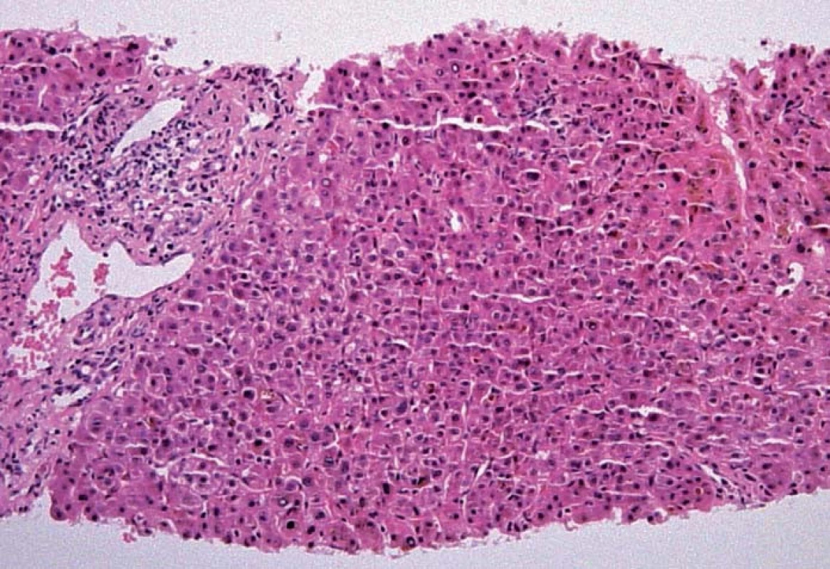 Histologický obraz akutní a subakutní cholestázy (HE 100×, bez morfologických známek typických pro PSC).
Fig. 4. Histological image of acute and subacute cholestasis (HE 100×, no morphological signs typical of PSC).