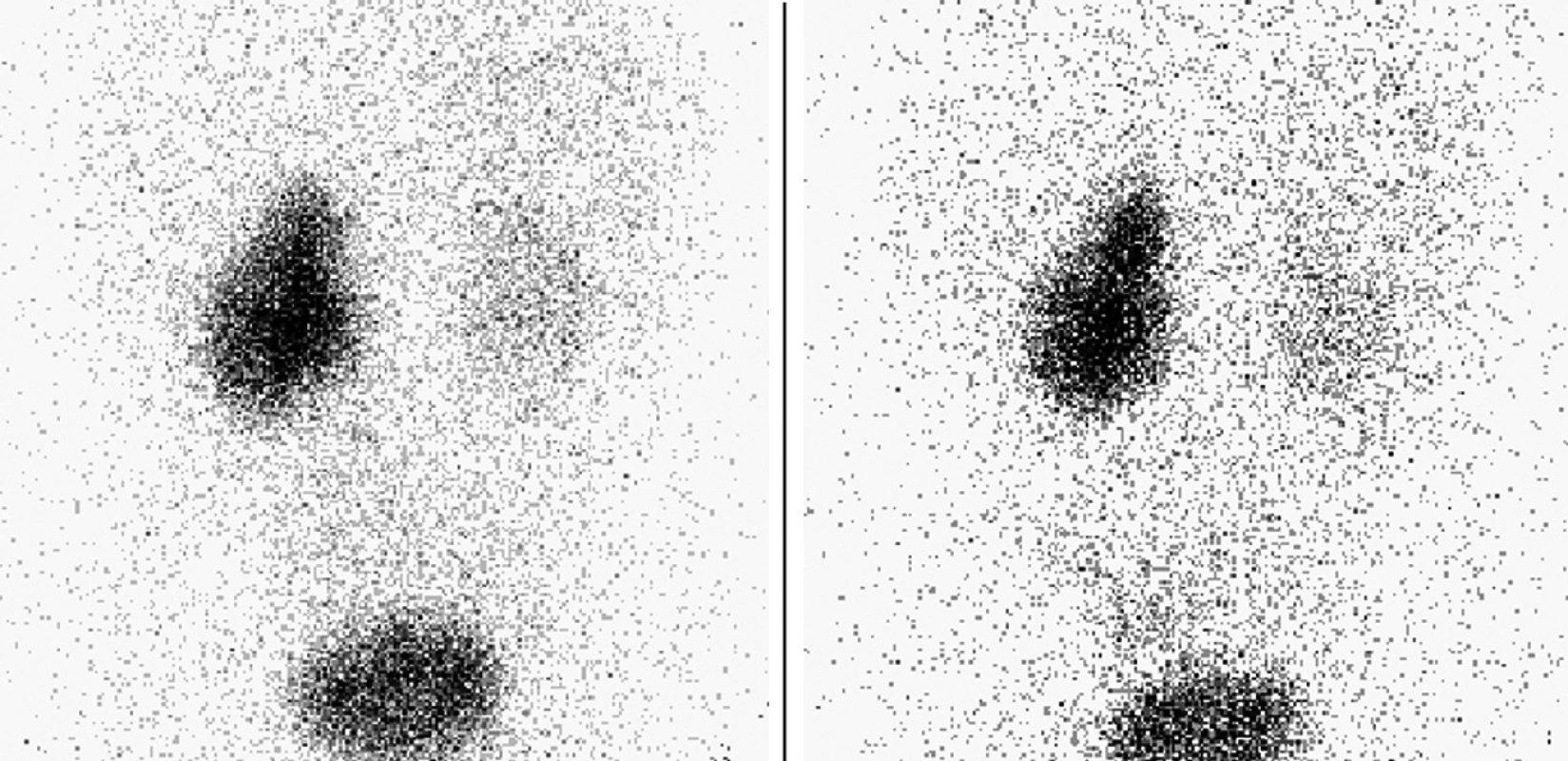 Kontrolní scintigramy za 30 a 60 minut po skončení studie a po vymočení s retencí aktivity v dutém systému levé ledviny.
Fig. 13. Examples of control scintigraphy after 30 and 60 min after the end of the study and after micturition with retention of activity in the hollow system of the left kidney.