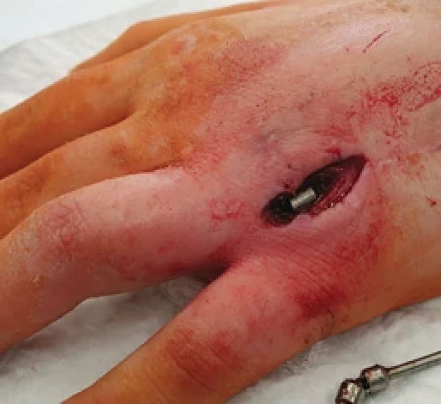 Intraoperative photo taken during the removal of the external activator rod.