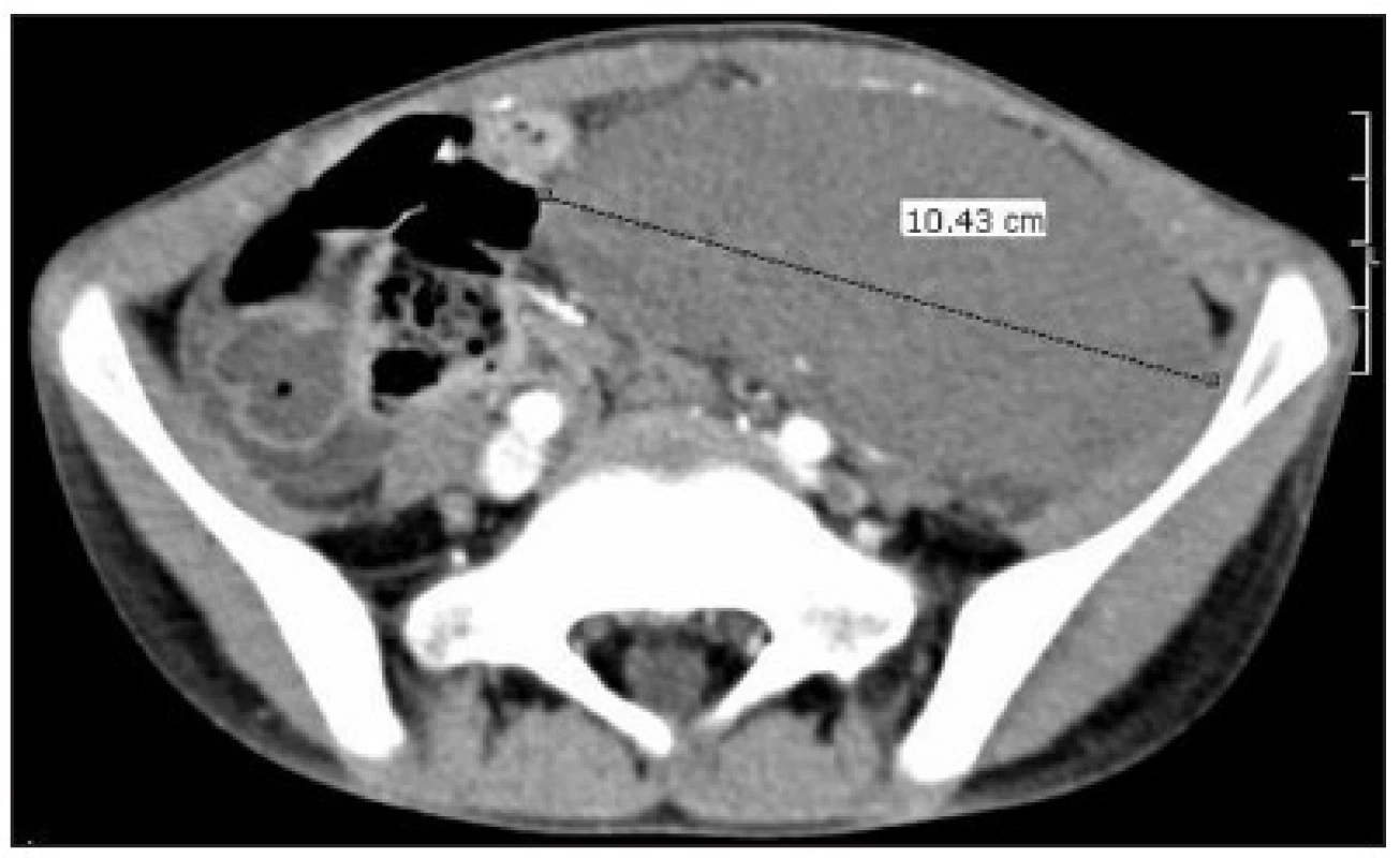CT obraz dystopicky lokalizovanej sleziny v ľavom podbrušku
Fig. 1. CT image of dystopic spleen