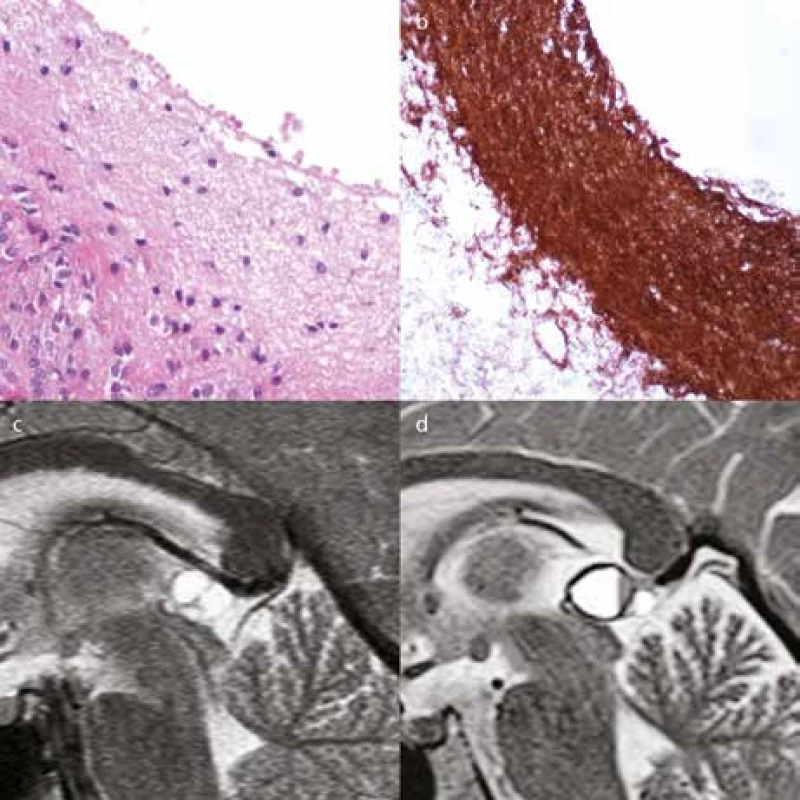 Histologie a varianty pineálních cyst.
