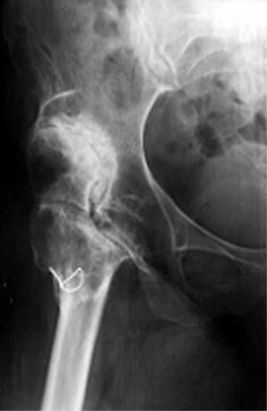 Postdysplastická deformita