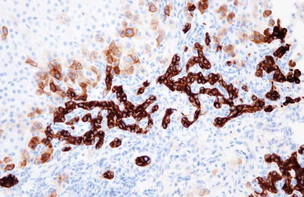 Aberantní imunoexprese cytokeratinu 7 v cholestatických hepatocytech, tzv. cholangiocelulární metaplazie hepatocytů (zvětšení 100x).