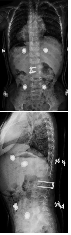 Pooperační zadopřední (a) a boční (b) rtg snímek pacientky ošetřené kombinovaným výkonem.
Fig. 2a, b. Postoperative anterior-posterior (a) and side (b) X-ray after the combined surgery.