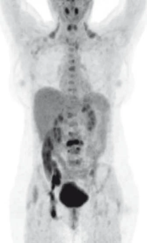 MIP (maximum intensity projection) – četná ložiska hypermetabolizmu FDG projikující se do skeletu – metastázy.