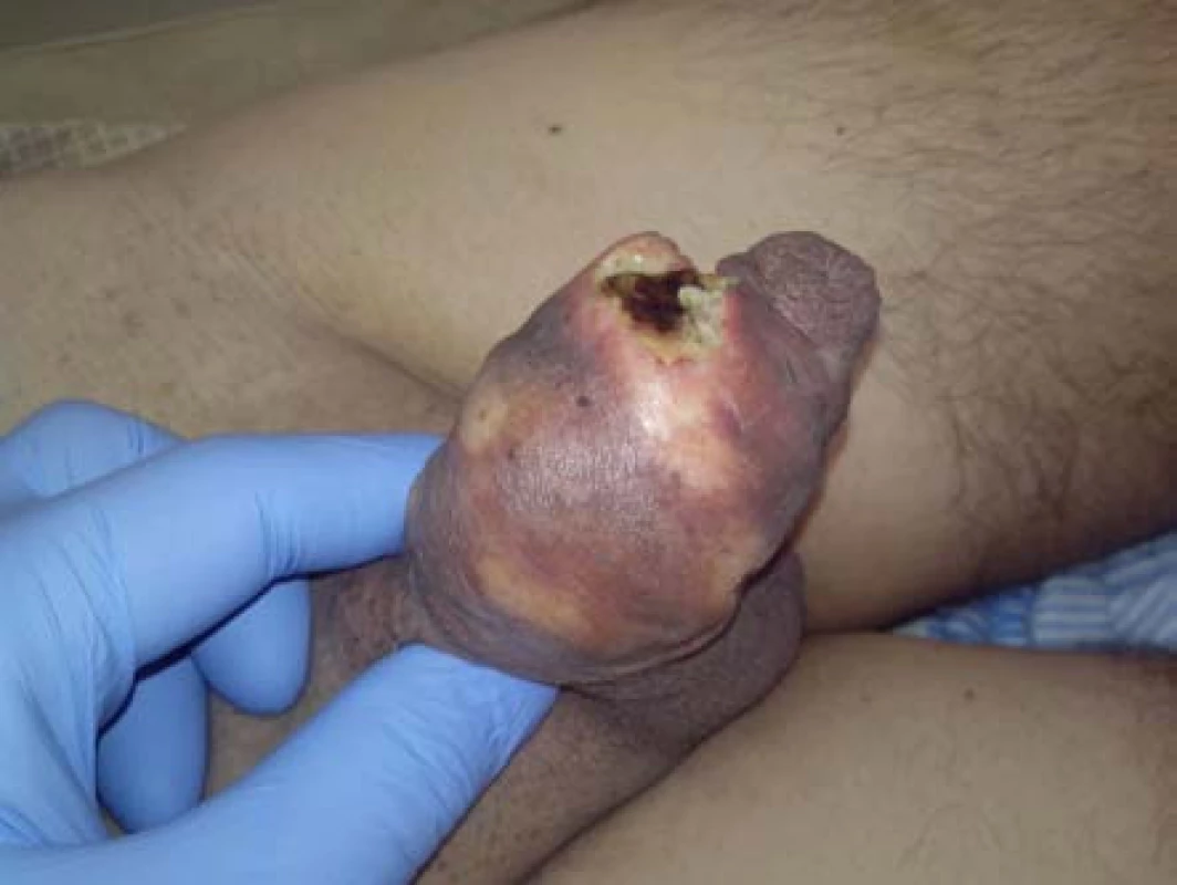 Indurace s nekrotickým ložiskem v terénu aplikované borové masti
Fig. 1. Induration with necrosis in the field of applied boric unguent