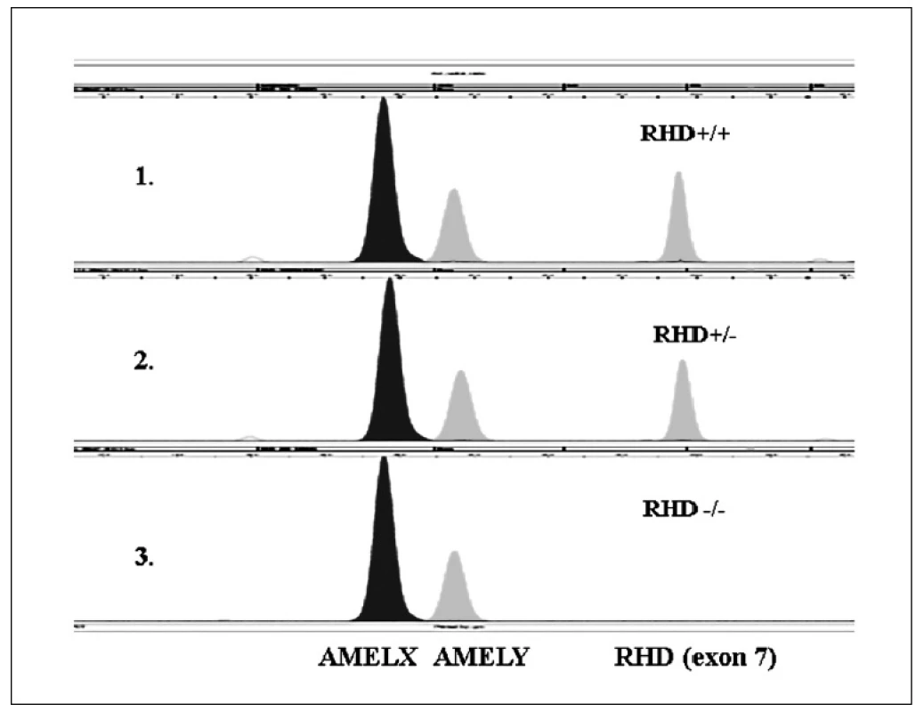 Ukázka rozlišení <i>RHD</i>  genotypů pomocí minisekvenace (SNaPshot).
1. V první řadě je ukázka <i>RHD</i> pozitivního homozygota. 2. V druhé řadě je ukázka <i>RHD</i> heterozygota. 3. Ve třetí řadě je ukázka <i>RHD</i> negativního homozygota.