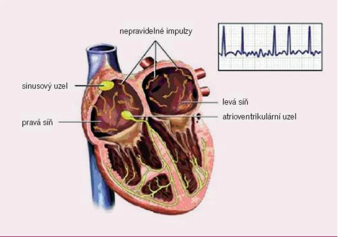 Elektrofyziologie fibrilace síní (převzato z http://catalog.nucleusinc.com).