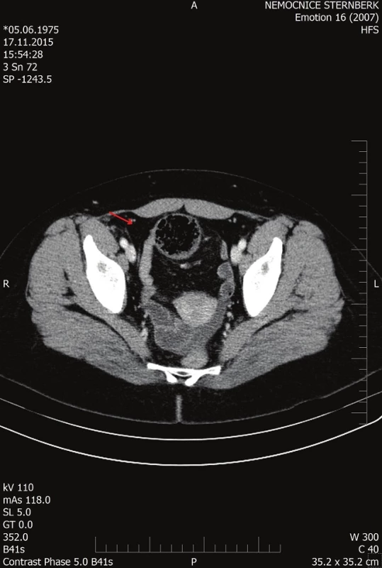 CT dilatované tenké kličky
Fig. 2: CT of the dilated small bowel loop