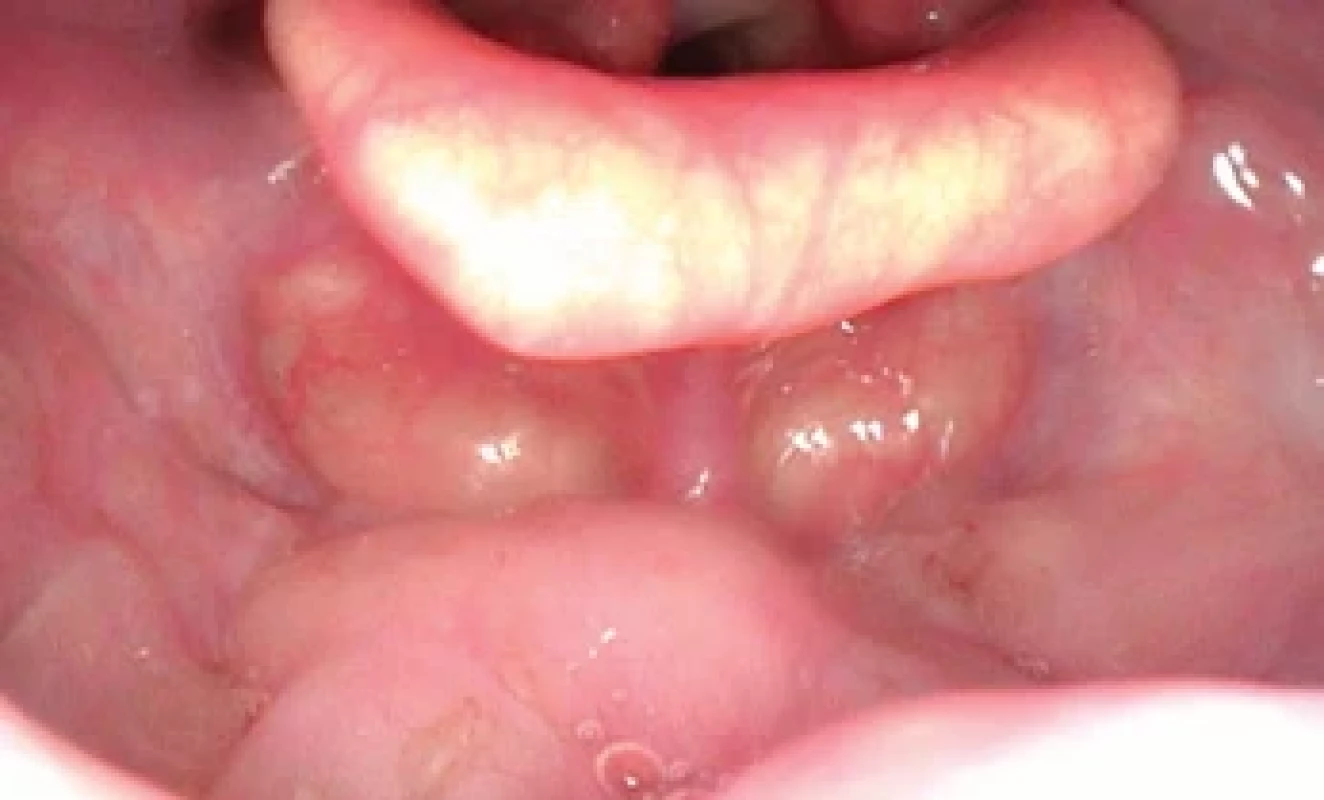 Pooperační vyšetření fl exibilní laryngoskopii – klidný nález v oblasti kořene jazyka. Postoperative examination of fl exible laryngoscopy – unremarkable fi nding in the area of the tongue base.