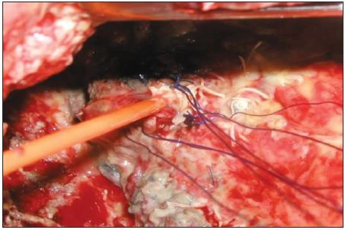 Peroperační snímek nasondované bronchopleurální píštěte u nemocného po pneumonektomii
Fig. 6. Intraoperative view – bronchopleural fistule with a probe inserted, a patient after pneumonectomy