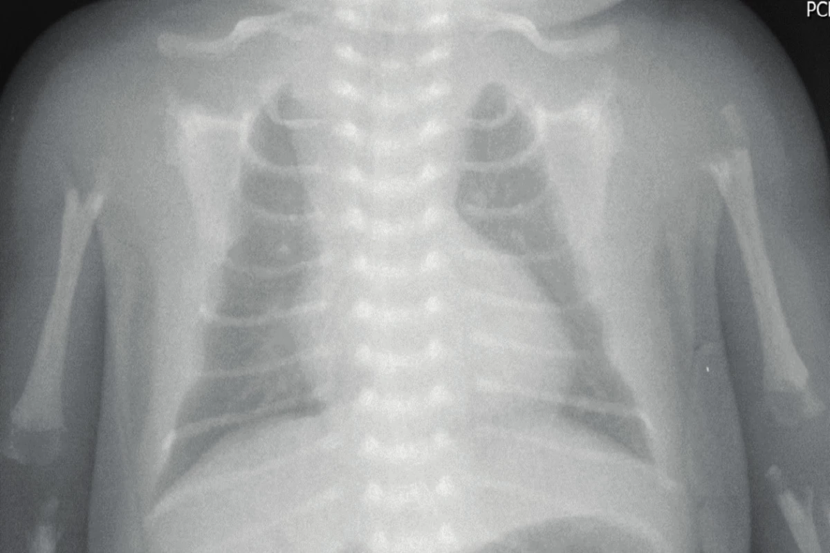 Rentgenogram hrudníku u dítěte s perinatální formou HPP ve věku 3 dnů. Je patrná těžká hypomineralizace skeletu (obrázek z archivu prof. MUDr. Z. Šumníka, Ph.D.).
Fig. 1. Chest X-ray of a 3-day-old neonate with perinatal HPP. Extreme skeletal hypomineralization is apparent.