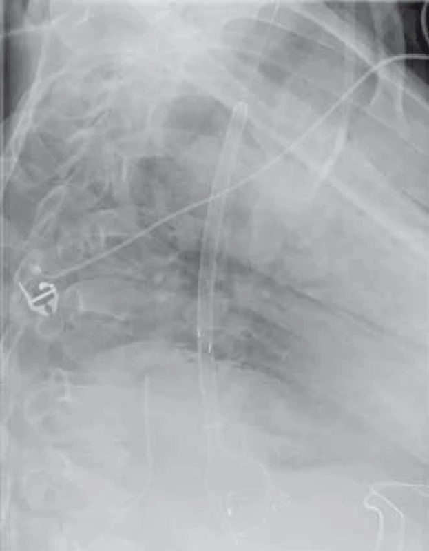 Extrakce Danišova stentu – radiologický obraz.
Fig. 3. Extraction of Danis stent – radiology image.