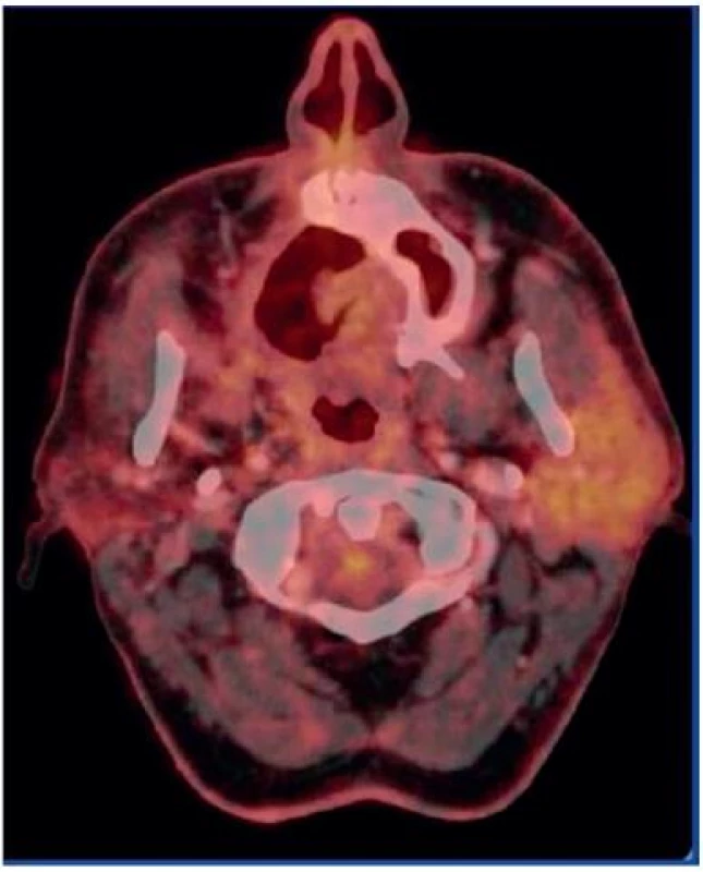 Axiální PET CT řez – stav po léčbě