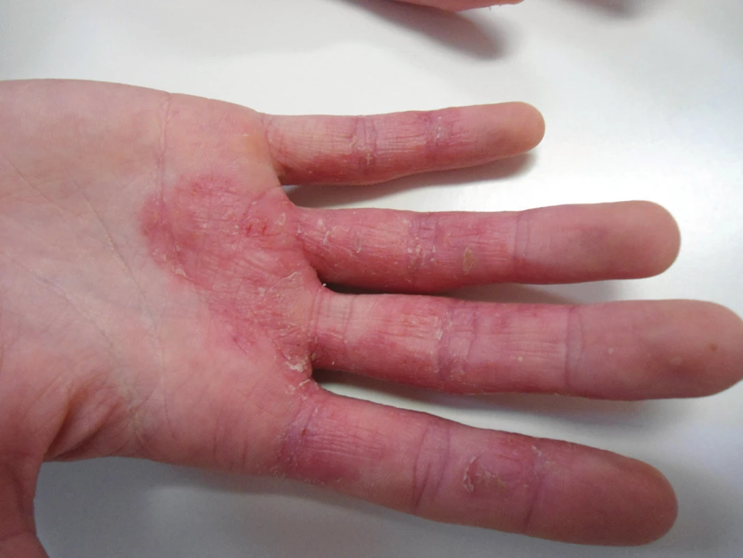Kontaktní proteinová dermatitida vyvolaná senzibilizací na rybí maso