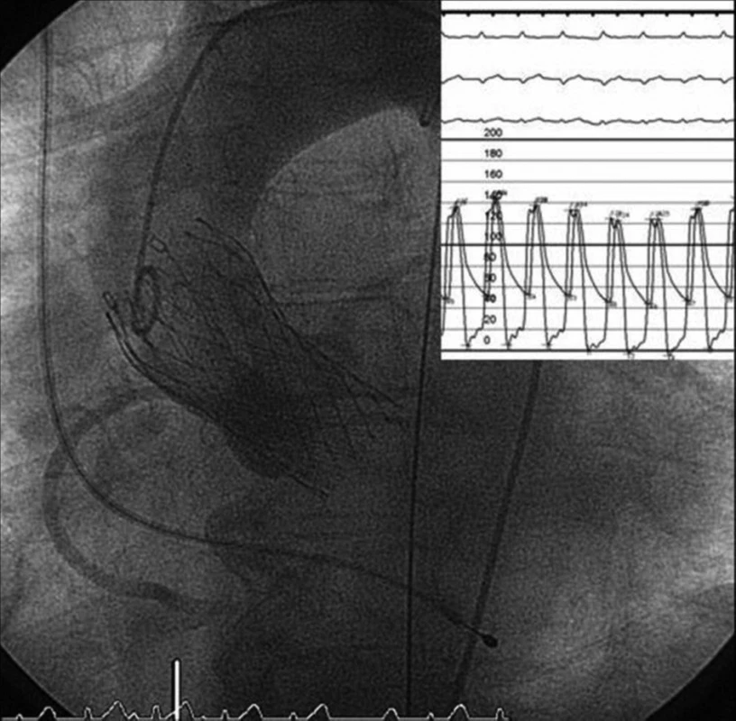Plně expandovaná chlopeň Corevalve<sup>®</sup> v optimální pozici, měření tlakových gradientů