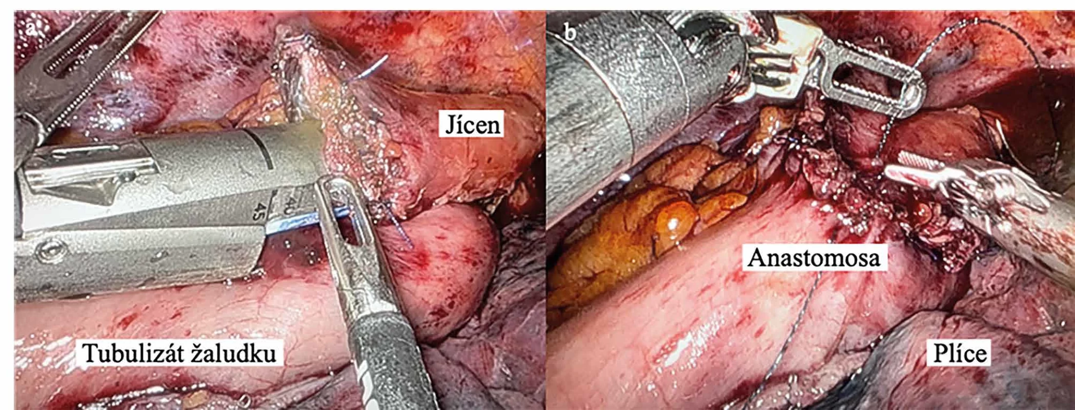 Esofagogastrická anastomóza   Fig. 2: Esophagogastric anastomosis
