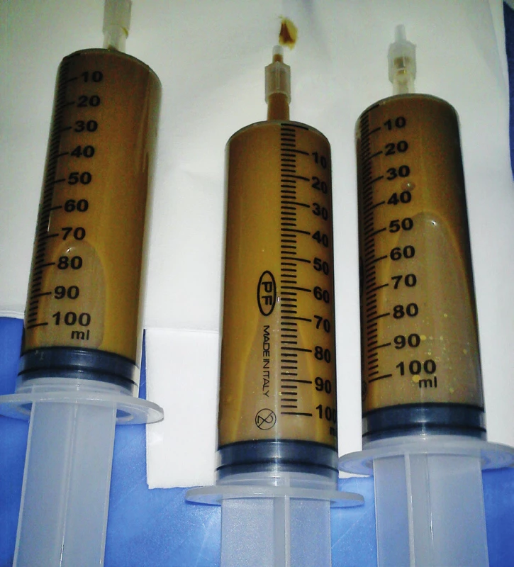 Fekální transplantát – 300 ml homogenizátu (archiv autora)