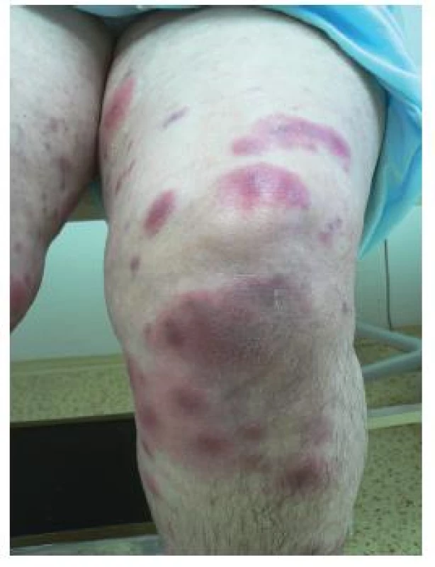 Projevy na dolních končetinách, klinicky připomínající erythema nodosum