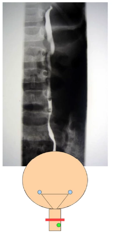 <i>Cystoskopia, sondáž ektopického ústia a retrográdna ureterografia vľavo močovodu horního segmentu</i>
Fig. 3. <i>Cystoscopy, catheterisation of ectopic ureteric orifice and left retrograde ureterography of ureter of the upper segment</i>