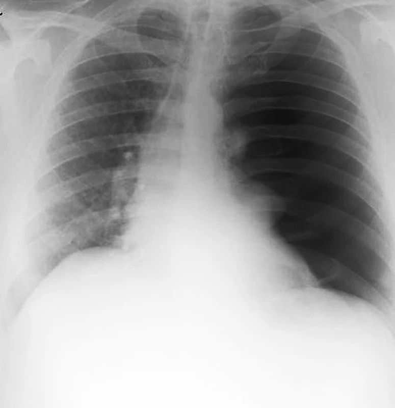 Snímek hrudníku odhalující kompletní levostranný kolaps plíce s přesunem mediastina na pravou stranu
Fig. 1: Chest radiography showing complete left-sided collapse of the lung and shift of the mediastinum to the right
