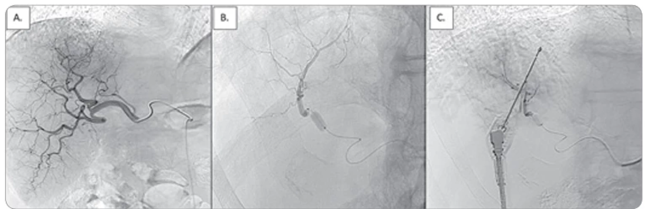(A) Selective hepatic digital subtraction angiography visualizing the tumor vasculature; (B) a 2.8-Fr microcatheter with an occlusion-balloon tip infl ated; (C) microwave antenna placement visualization. 