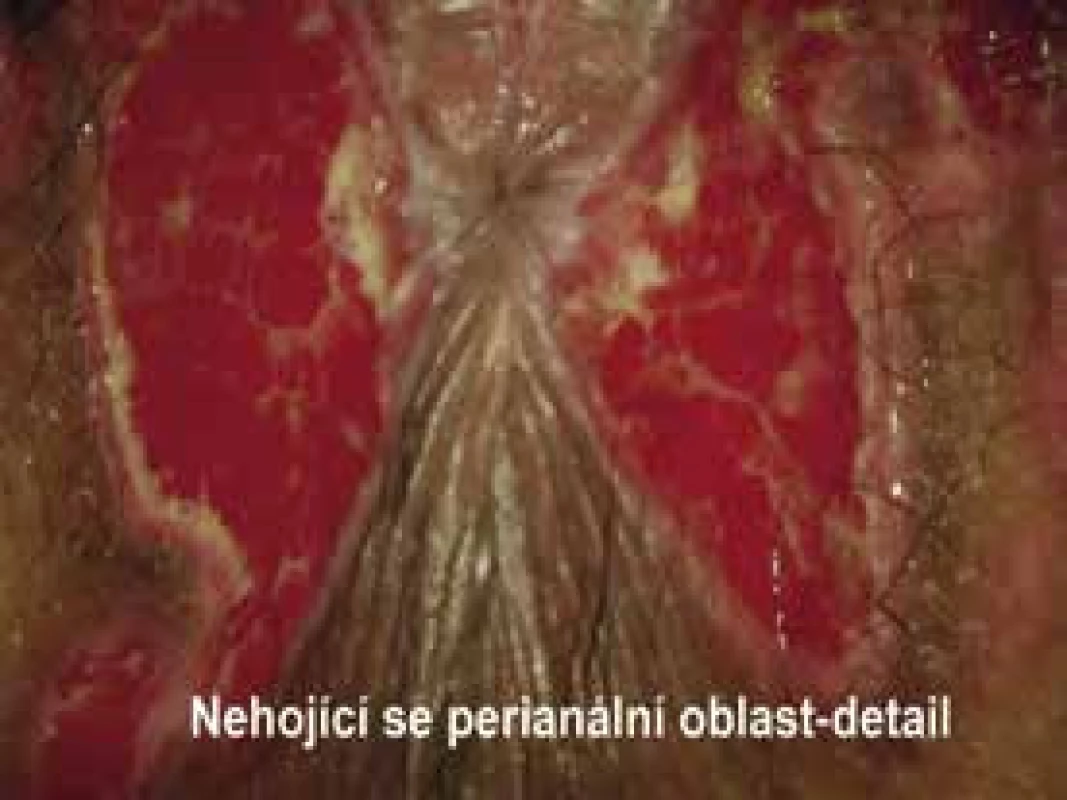 Široce přisedlý zánětlivý polyp – detail