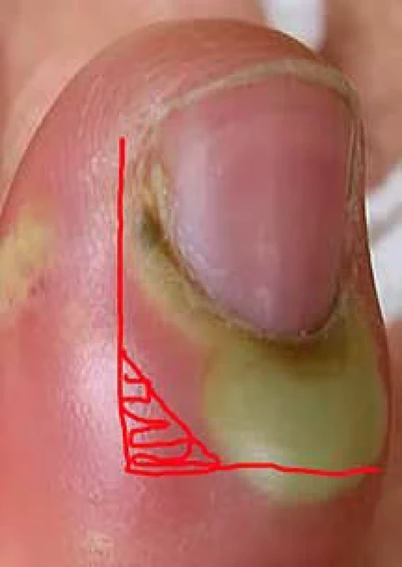 Paronychium – incize ve tvaru L podle Iselina. 