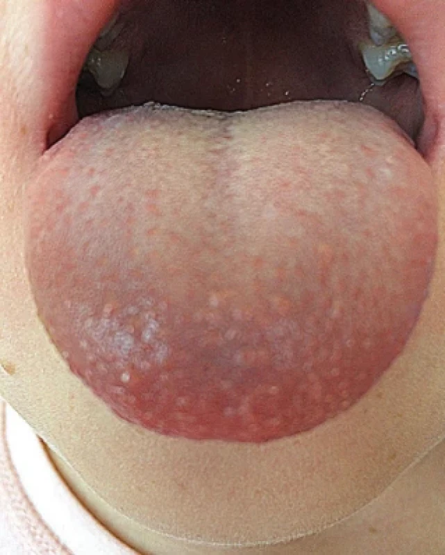 Mnohočetné drobné papulky na hřbetu a hrotu jazyka ve věku šest let. Zdroj: Dokumentace pacientky. Fig. 2 Multiple small papules on the dorsum and tip of the tongue at the age of 6 years. Source: Patient’s medical records.