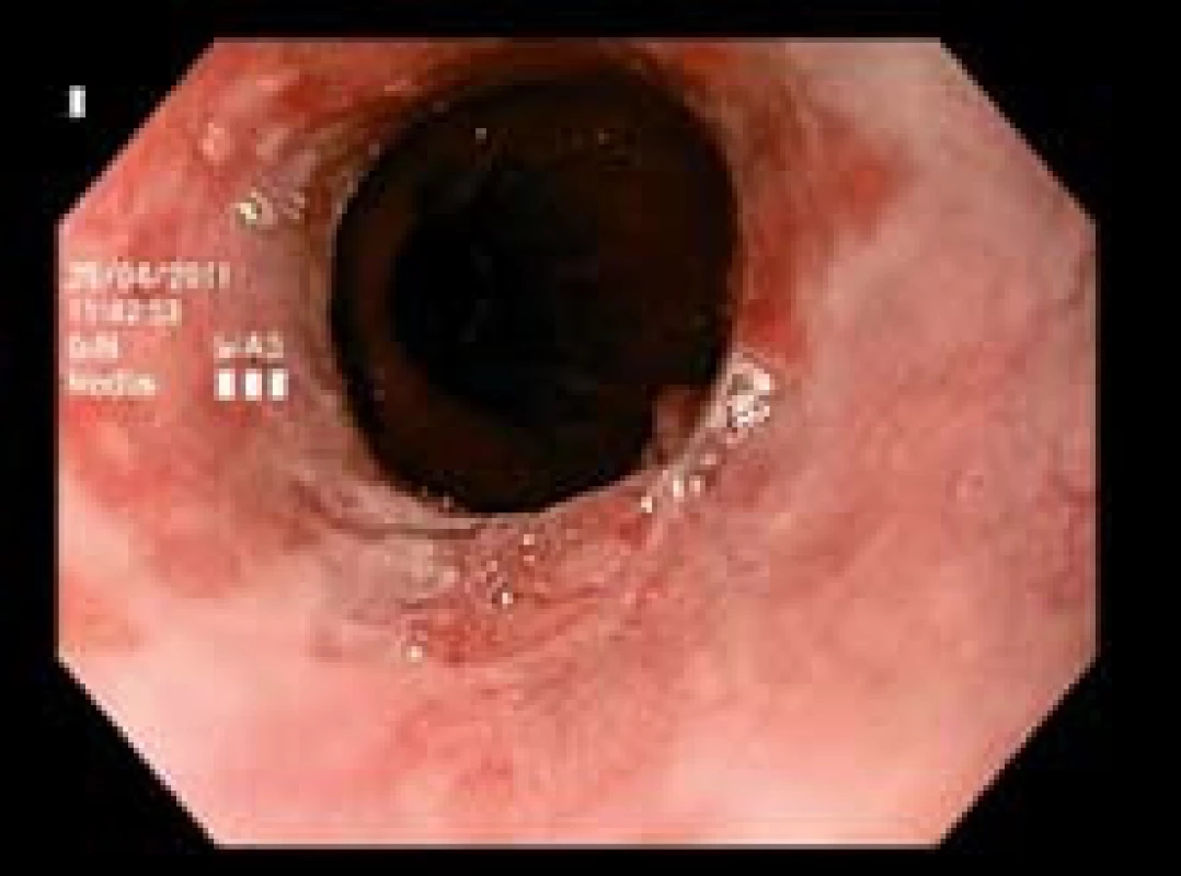 Kontrola po měsíci po první etapě EMR. Reziduální nepravidelný segment Barrettova jícnu s malou prominencí na spodině jizvy.
Fig. 2. One month after the first session of EMR. Residual irregular segment of Barrett’s esophagus with a small prominent lesion on the bottom of the scar.
