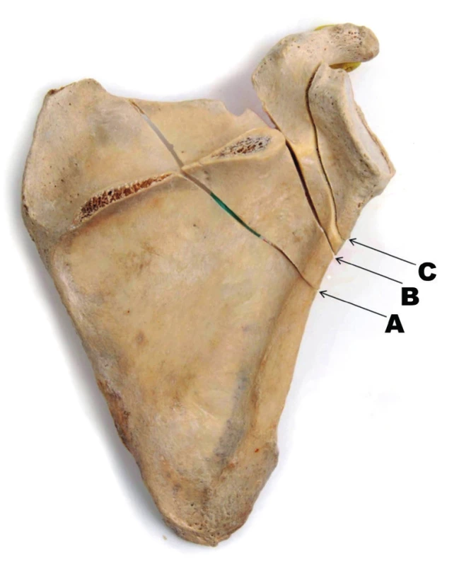 Zlomeniny krčku lopatky – anatomický preparát: A – transspinózní zlomenina krčku; 
B – zlomenina chirurgického krčku; C – zlomenina anatomického krčku.
Fig. 7: Fractures of scapular neck – anatomic specimen: A – transspinous fracture of scapular neck; 
B – fracture of surgical neck; C – fracture of anatomic neck.