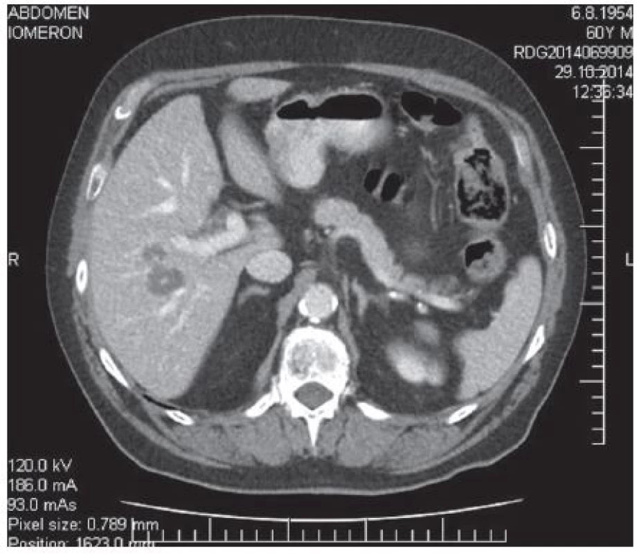 Předoperační CT vyšetření – není difuzní jaterní postižení
Fig. 2: Preoperative CT scan – no diffuse liver lesions