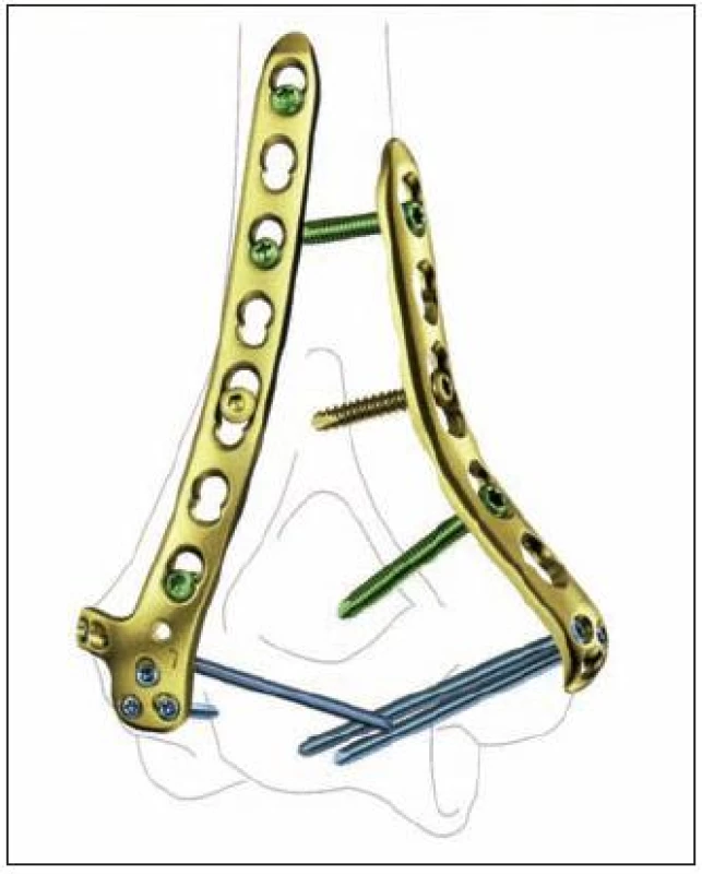 Anatomicky tvarované zamčené dlahy pro distální humerus