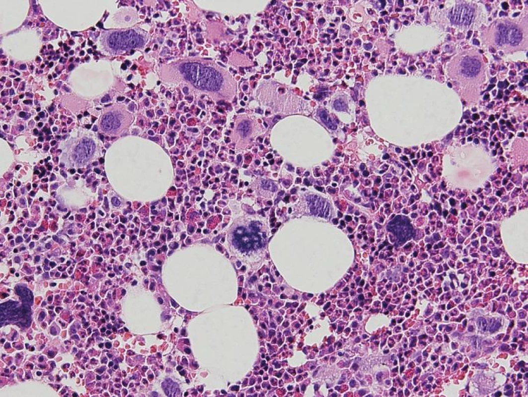 Prefibrotické štádium PMF – hypercelulárna KD s proliferáciou bieleho a mgk radu. Veľké MGK s objemnými, hypolobulizovanými jadrami a rozptýleným chromatínom („obláčikovité“ jadrá) a MGK s výrazne denznými a bizardnými jadrami (dysplastické MGK) (hematoxylín-eozín 200x).