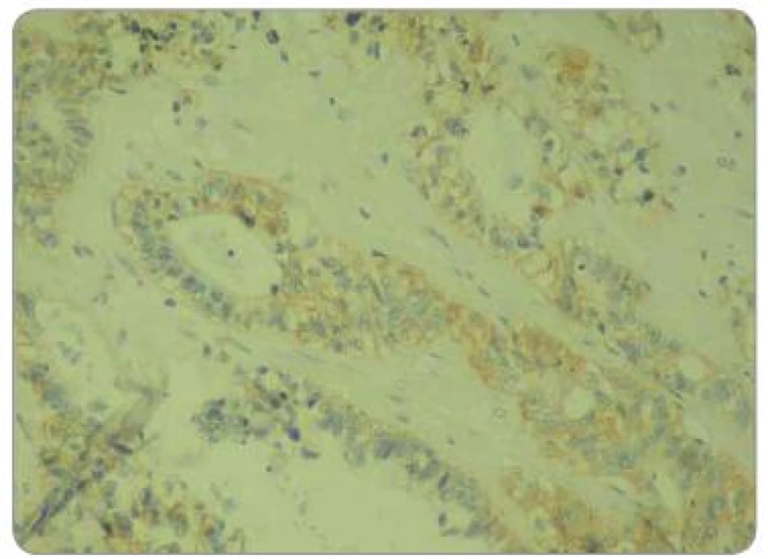 Hodnocení intenzity exprese EGFR pomocí IHC: EGFR 2+, zvětšení 200×.