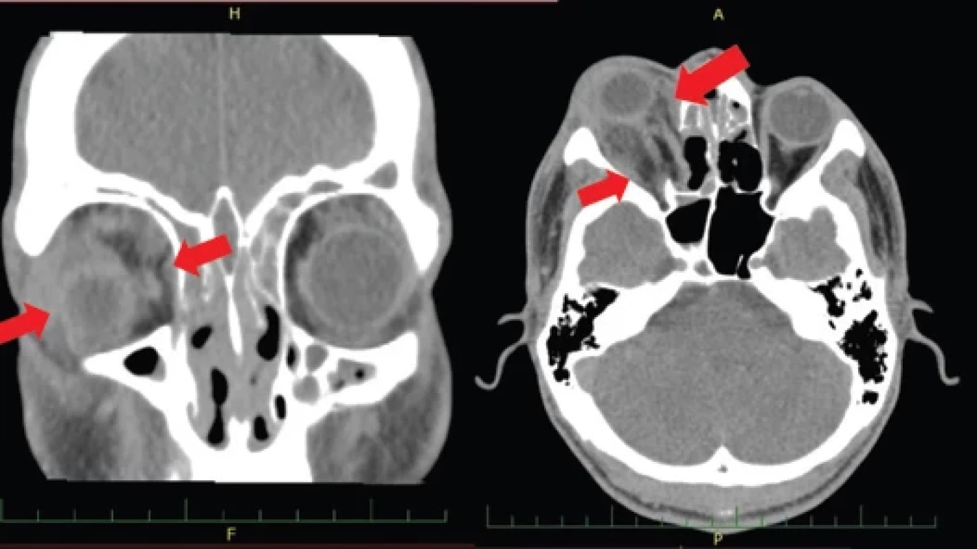 CT 2. pooperační den, vlevo koronární projekce, vpravo axiální. Lokalizace abscesu vyznačena šipkami.