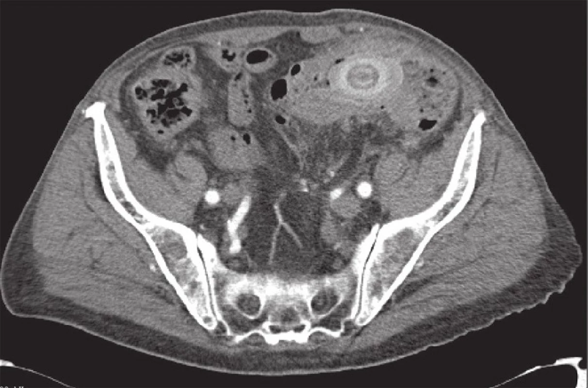CT obraz – tumorózní stenóza colon sigmoideum s obstrukcí biliárním konkrementem
Fig. 2: Tumour-like stenosis of the sigmoid colon with gallstone obstruction (computed tomography finding)