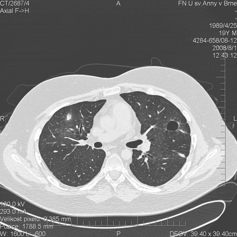 Multidetektorové CT 64 řady GE Lightspeed VCT: HRCT plic: Vymizení denzit mléčného skla. Došlo k výrazné regresi sledovaných ložisek v plicním parenchymu.V pravém plicním křídle již žádné ložisko není patrné, pouze drobná cípatá zastínění v jejích původní lokalizaci.Vlevo pouze solitární dutina ve ventrálním segmentu horního laloku.