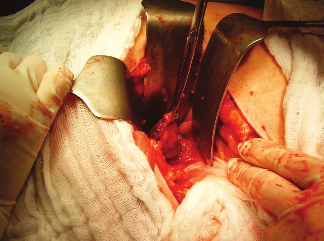 Hartmannova výchlipka s prosvítajícími tu hmotami v lumen
Fig. 3. Hartmann‘s evagiation with the tumour mass visible in the lumen