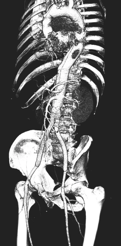 CTAkontrola rok po resekci subrenální aorty technikou aortální fenestrace s ABI rekonstrukcí
Pic. 17. A CTA check up a year after the resection of the subrenal aorta using the technique of aortic fenestration with ABI reconstruction