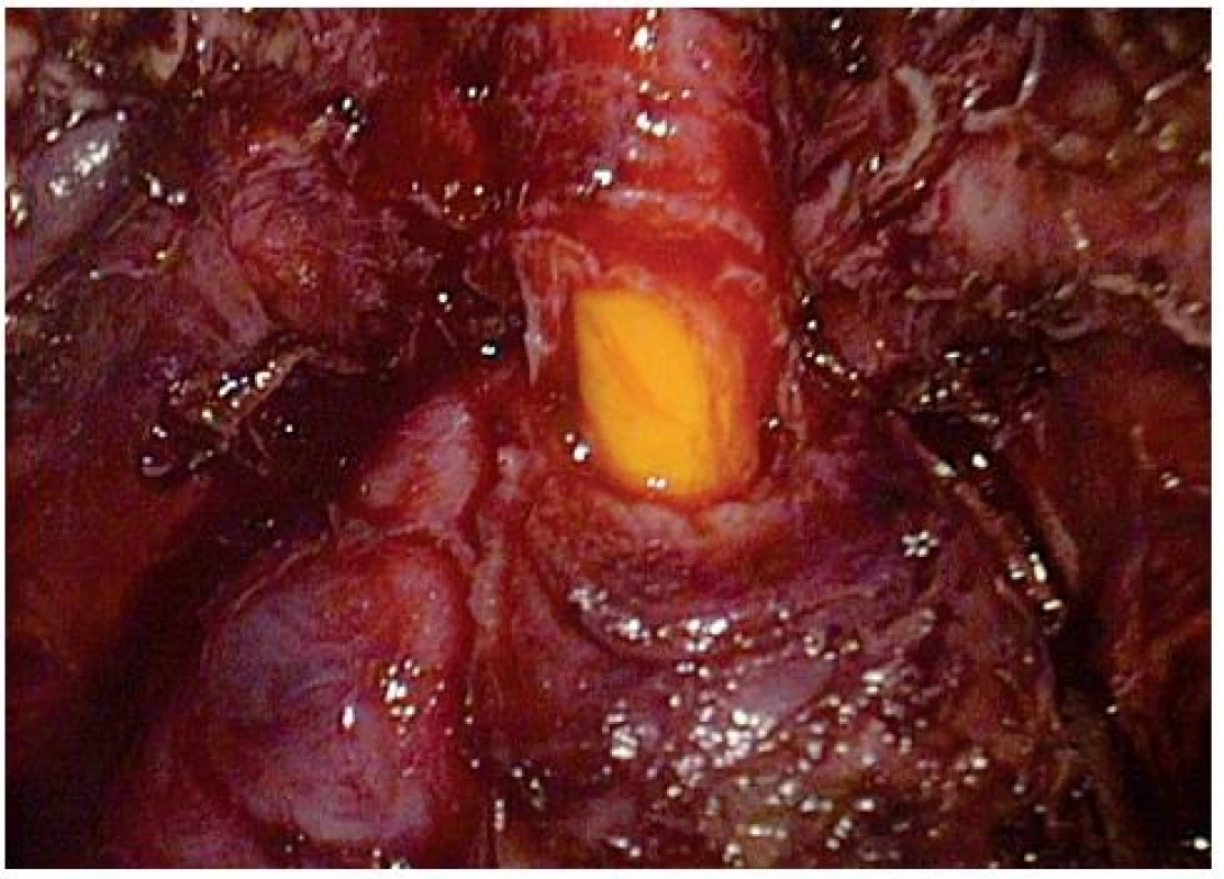 Odstřižení uretry
Fig. 6. The cut of the urethra