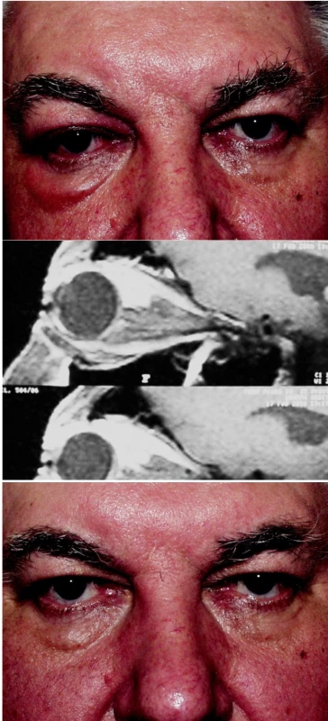 a. Axiální protruze pravého oka s chemózou spojivky
b. MR: difuzní postekvatoriální infiltrace v okolí horního přím. svalu
c. Normalizace polohy oka po kortikosteroidní terapii